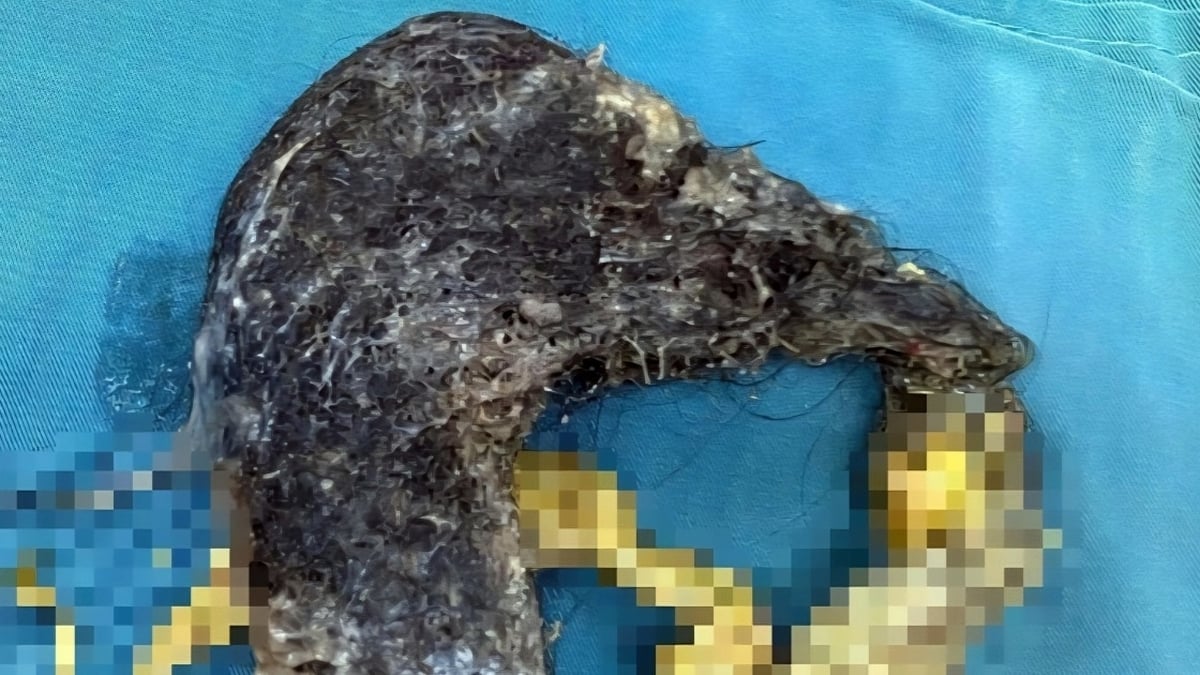 5-jähriger Junge hat seltene Krankheit und isst fast 0,5 kg Haare