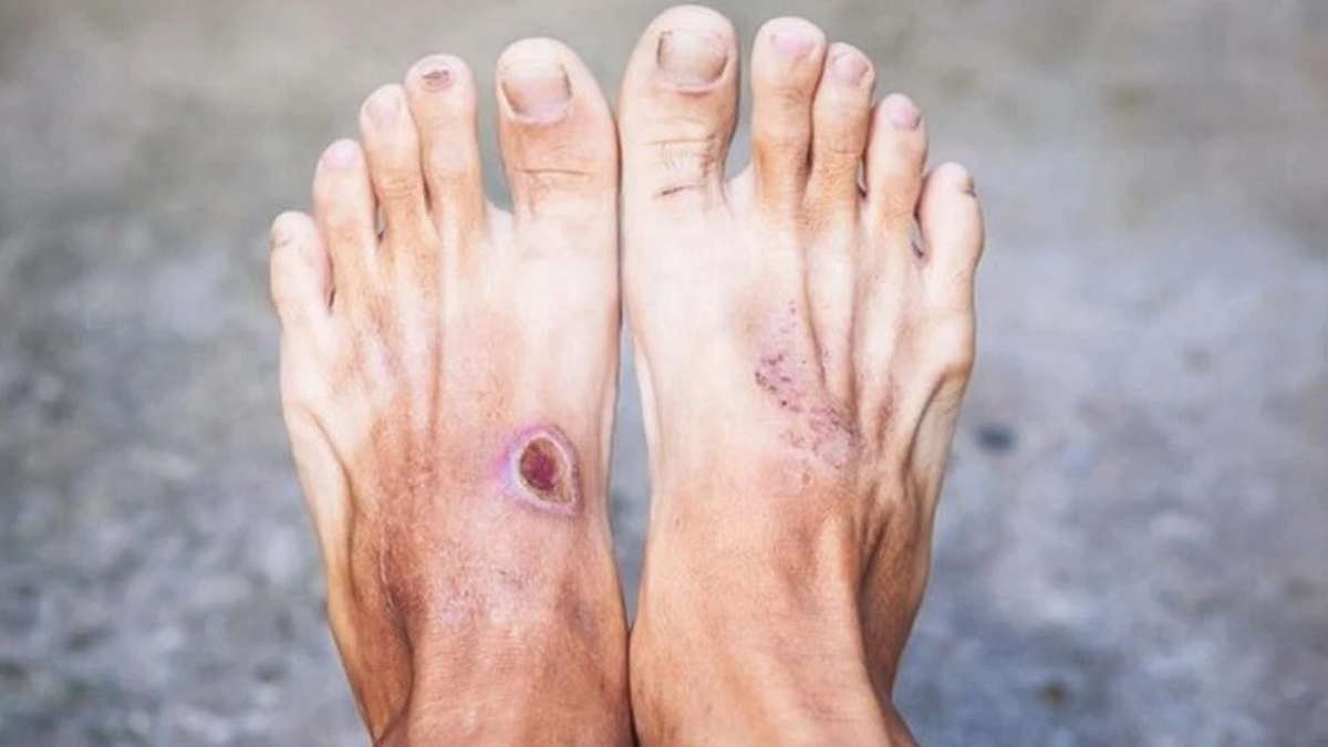 Why are skin ulcers in diabetics often difficult to heal?