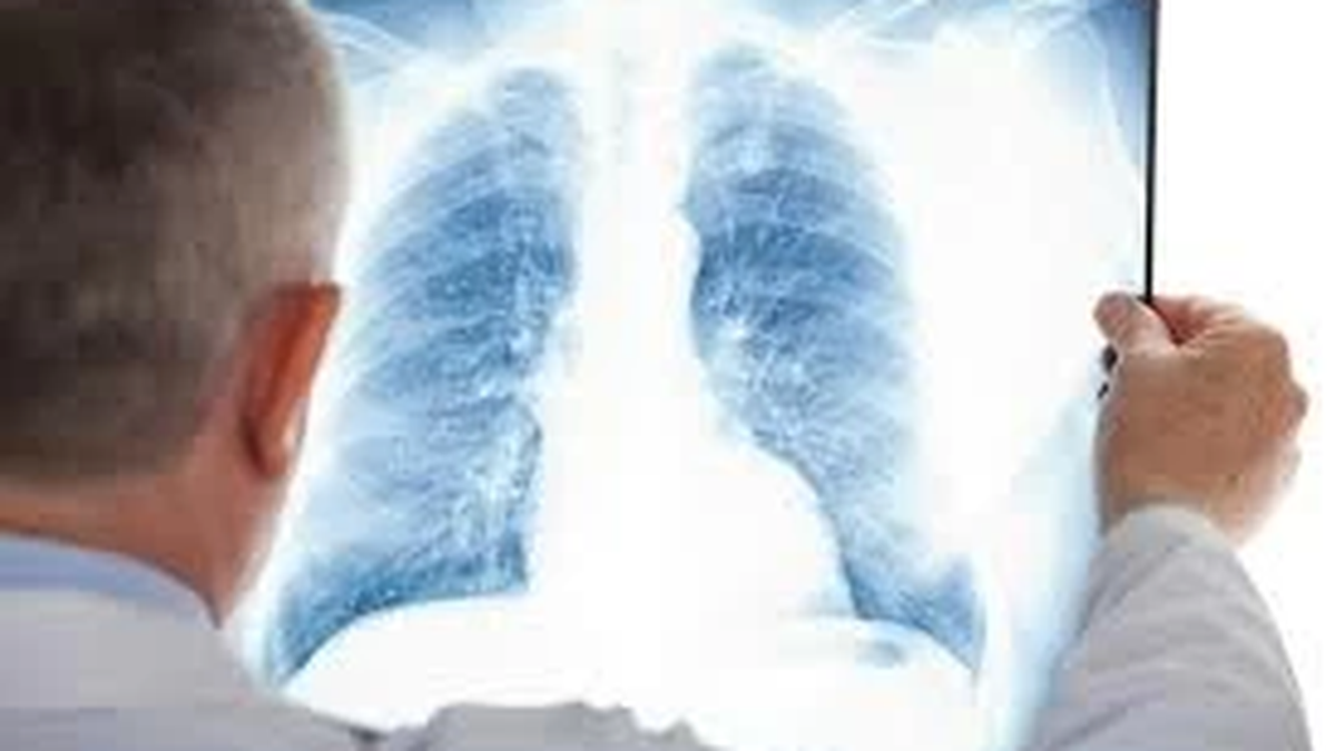 What to do with pulmonary fibrosis after tuberculosis treatment?