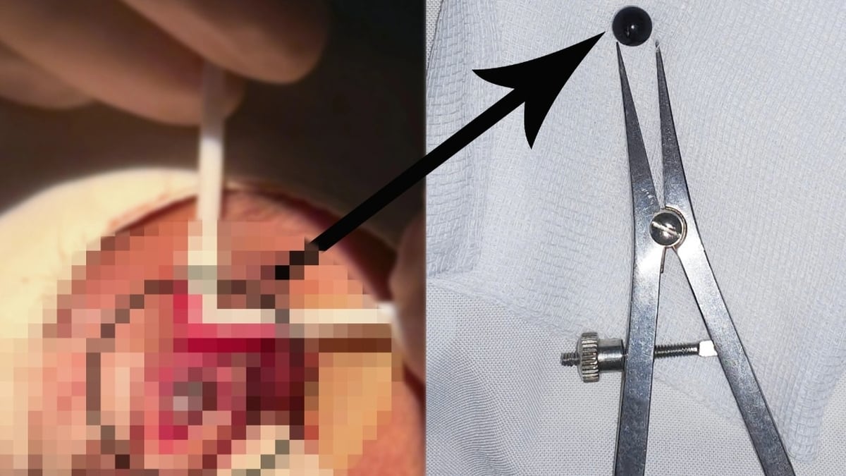 Tratamiento de emergencia para un estudiante de 15 años que recibió un disparo de una bala de hierro que le quedó atrapada en el ojo durante muchos días.