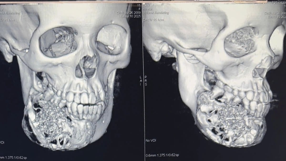 Después de 9 horas de cirugía, los médicos rescataron a una joven de un tumor gigante en su rostro.