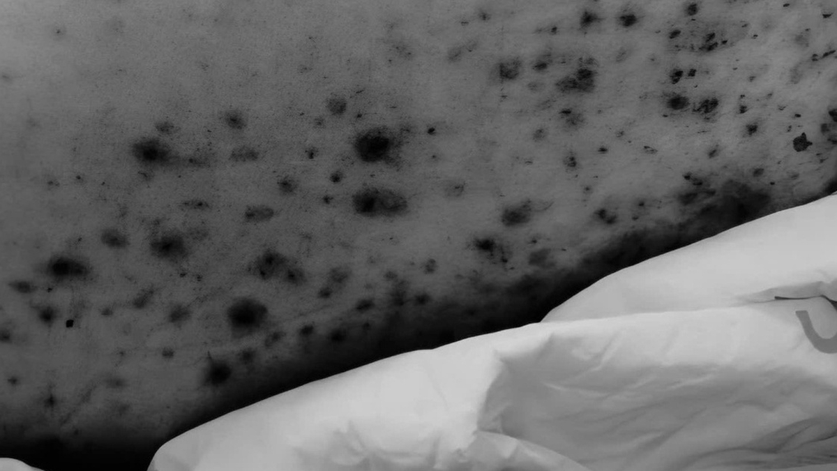 30-jähriger Mann in kritischem Zustand aufgrund von Windpocken, einer Krankheit, die bei Kindern häufig vorkommt