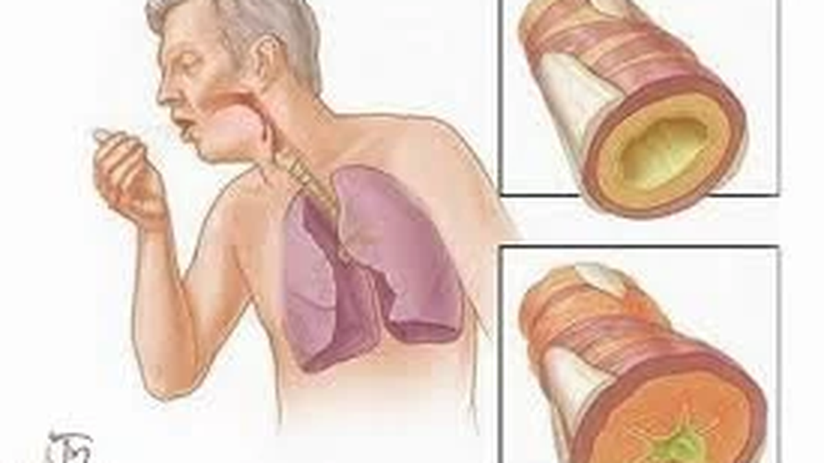 Coughing and phlegm in the throat after tuberculosis treatment, which department should I go to?