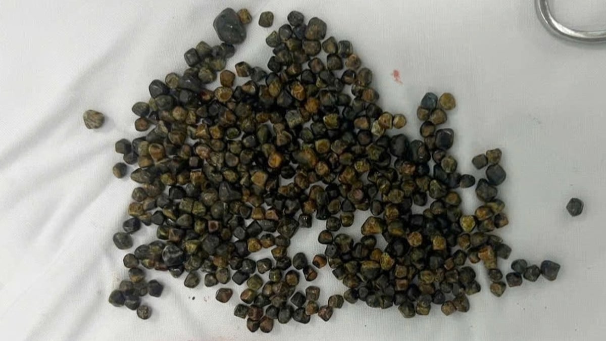 Surgery in the US failed, Vietnamese woman had 481 gallstones removed by doctors in Ho Chi Minh City