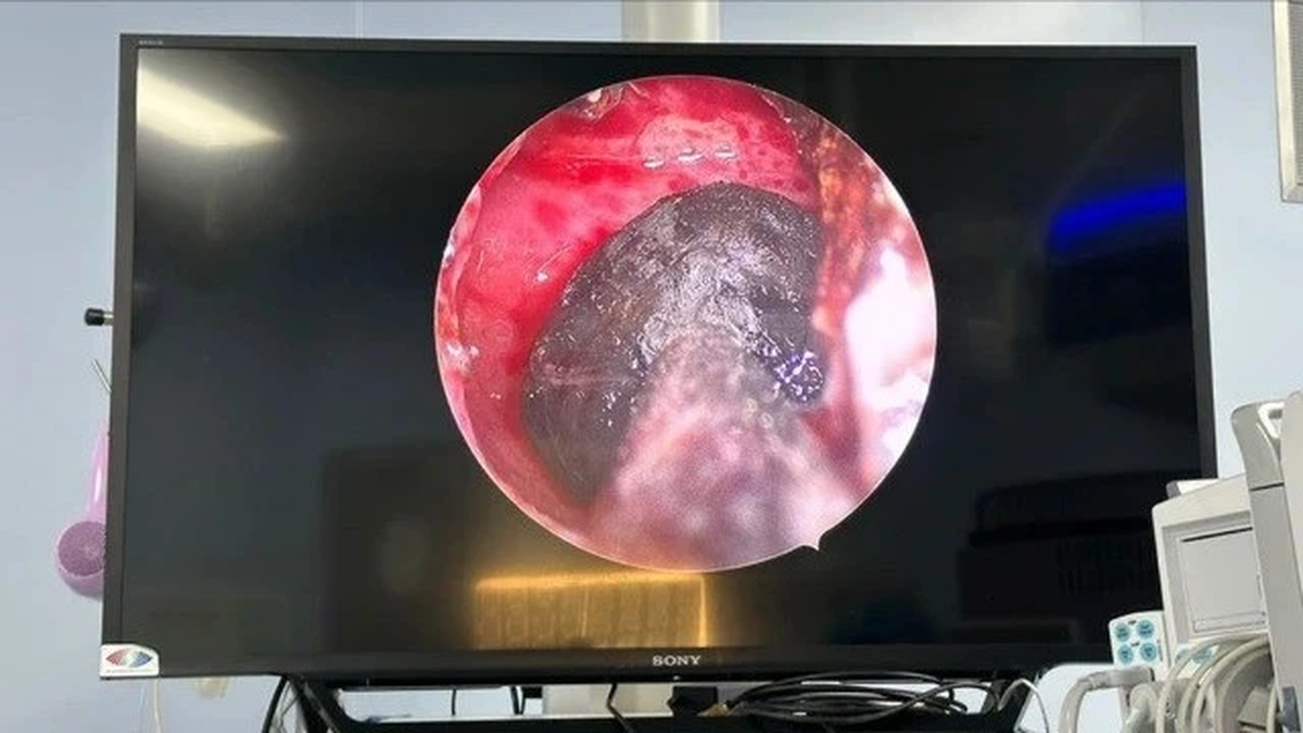 数ヶ月にわたる鈍い頭痛の後、蝶形骨洞に真菌が見つかった