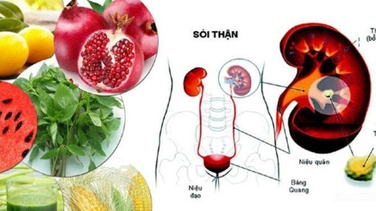 Top Simple Remedies to Prevent Kidney Stones