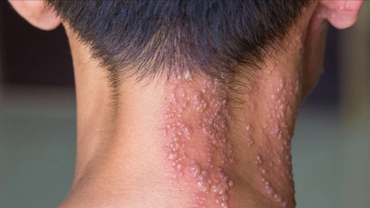 Facial paralysis due to shingles: Complications not to be underestimated