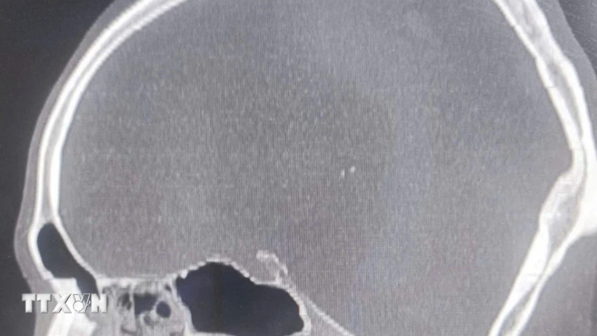 Thanh Hoa: Successfully treated patient with steel drill piercing through nasal cavity
