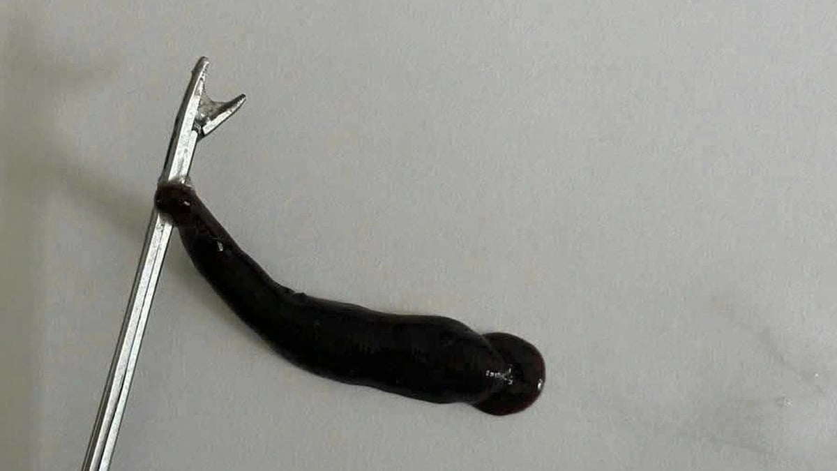 علقة كبيرة في أنف صبي يبلغ من العمر 14 عامًا