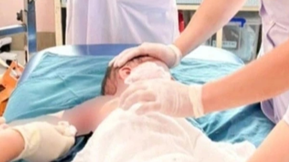 Hanoi: Tres niños de una familia quemados al volcar una olla caliente