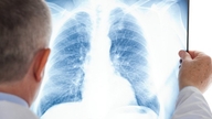 4 misconceptions about lung cancer
