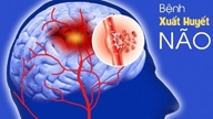 Recomendações para a prevenção de acidente vascular cerebral e hemorragia cerebral.