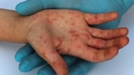 Um paciente com varíola dos macacos teve contato com 8 pessoas. Como podemos prevenir novas infecções?