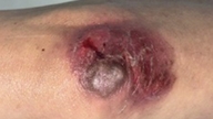 दवा की विषाक्तता के कई मामले गलत खुराक के कारण होते हैं।