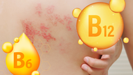 هل من الممكن رعاية ودعم علاج مرضى الهربس النطاقي باستخدام الطعام؟