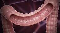 O câncer de cólon é hereditário? Como ele pode ser prevenido?