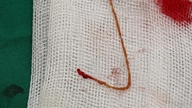 La donna soffriva di calcoli biliari e ascessi epatici dovuti a un'infezione parassitaria causata da un verme.