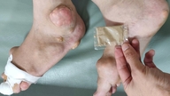 De nombreuses personnes subissent des pertes financières et des problèmes de santé après avoir acheté des médicaments contre la goutte sur les marchés ou en ligne.