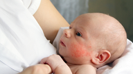 Hvilke typer allergier er almindelige hos børn?