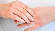 5 effektive foranstaltninger til at forbedre tilstanden af ​​atopisk dermatitis.