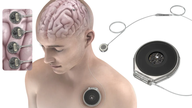 Конкурента Neuralink тестують на імплантацію чіпів у людський мозок.