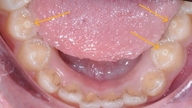 Dentes com cúspides acessórias – risco de complicações se não forem tratados prontamente.