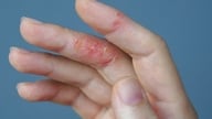 Atopisk dermatitis forværres i koldt og tørt vejr.