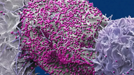 Mies parani HIV-tartunnasta kantasolusiirron jälkeen.