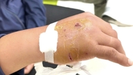 Instruções do médico sobre como lidar com uma mordida de cachorro.