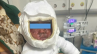 Akuttbehandling reddet en ni måneder gammel gutt med alvorlige brannskader fra kokende vann.