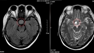 Seorang lelaki dengan penglihatan kabur yang berterusan menemui tumor pituitari semasa pemeriksaan mata.