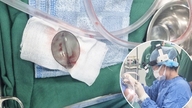 Rettidig operation for at fjerne plastikske fra 4-årig drengs luftveje.