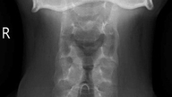Selepas mengalami sakit leher yang berterusan selama 5 bulan, seorang lelaki berusia 26 tahun telah didiagnosis dengan ankylosing spondylitis.
