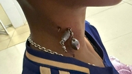 El anzuelo estaba clavado profundamente en el cuello del niño.