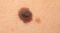 Quello che era iniziato come un innocuo neo pruriginoso si è inaspettatamente trasformato in un cancro della pelle.