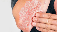 Peste 288.500 de adulți trăiesc cu psoriazis.