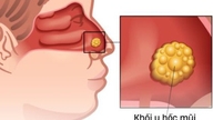 อาการคัดจมูกเรื้อรังอาจเป็นสัญญาณของมะเร็งโพรงจมูก
