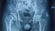 Hun fik diagnosen knoglemarvsskade efter at have lidt af hoftesmerter i årevis.