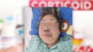 « Je me sentais bien quand j'en buvais », mais mon visage est défiguré et je souffre d'insuffisance surrénalienne chronique due à un abus de corticostéroïdes.