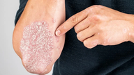 Onko psoriaasi vaarallinen?