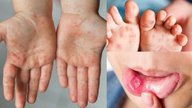 Godkännande för marknadsföring av ett vaccin mot hand-, fot- och klövsjuka.