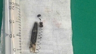 Operation for at fjerne en kuglepenfjeder, der havde været 'inaktiv' i tindingeområdet i 13 år.