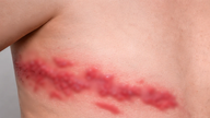 Warning: Increased risk of shingles in people with chronic diseases.