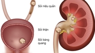 5 punca yang meningkatkan risiko batu karang ureter dan kaedah pencegahan yang berkesan.