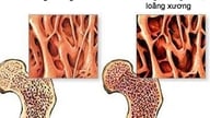 5 maneras de prevenir la osteoporosis sin medicamentos antes de los 40 años.