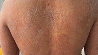 Incorrect use of medication caused the fungal skin infection to spread throughout the body, resulting in intense itching.