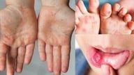 Käsi-, jalka- ja suutautitapausten määrä saattaa kasvaa lähitulevaisuudessa.