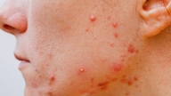7 faktorer, der fører til inflammatorisk akne på huden.