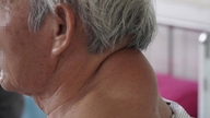 72세 남성의 목 뒤쪽에 있던 '거대' 종양을 수술로 제거했습니다.
