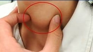 Øger thyroiditis risikoen for kræft?
